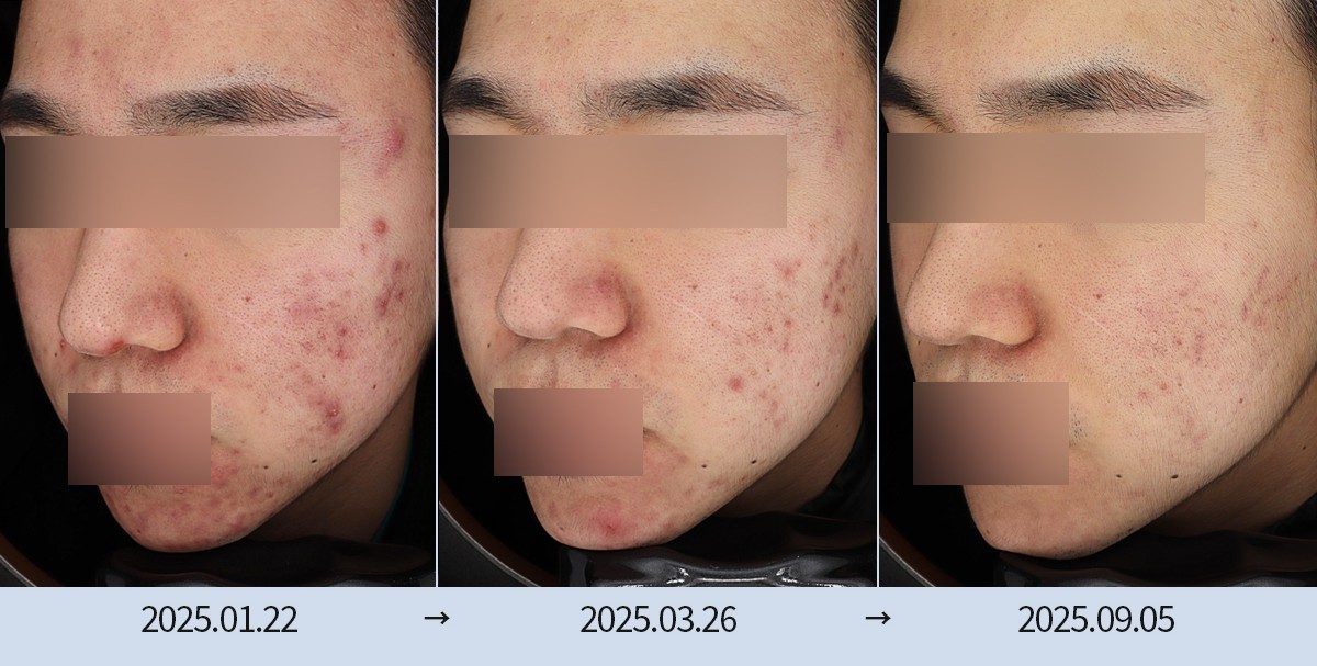 스노우의원 다산점 모공·흉터 시술 전후