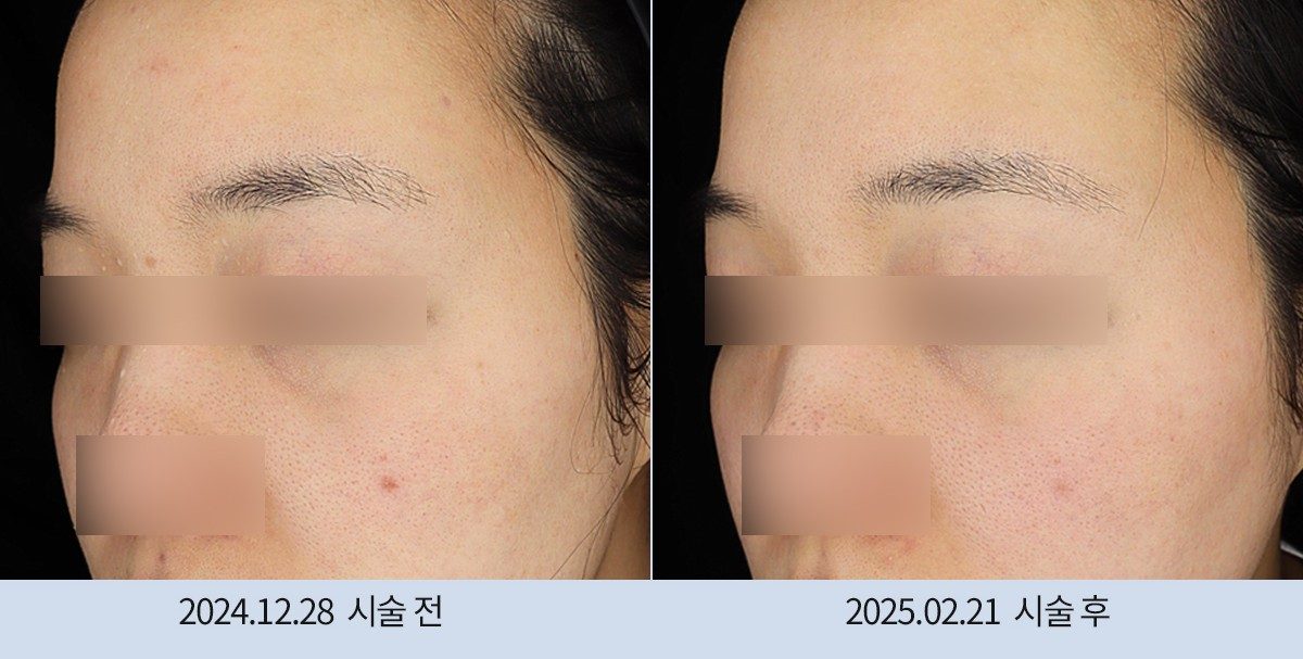 스노우의원 다산점 모공·흉터 시술 전후